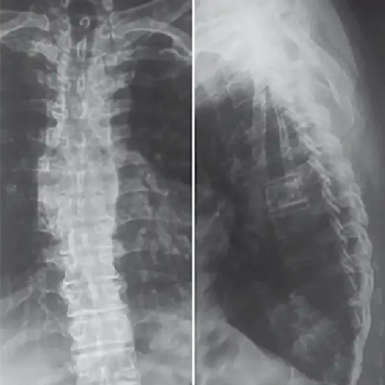X-Ray Dorsal Spine AP View Test